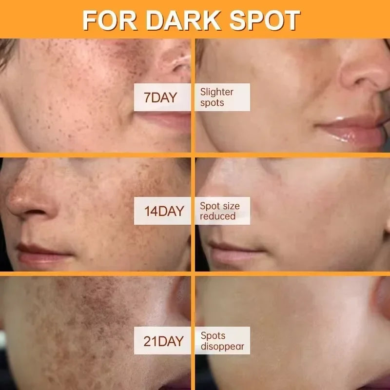 Dark Spot & Freckle Corrector Face Cream (Niacinamide + Vitamin C)