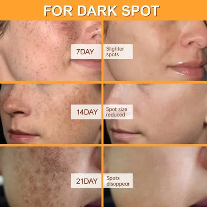 Dark Spot & Freckle Corrector Face Cream (Niacinamide + Vitamin C)